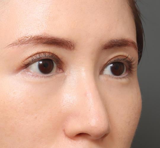 20代女性の眉下切開法 After 症例写真