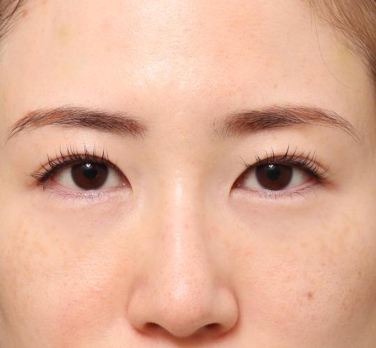 20代女性の眉下切開法 Before 症例写真