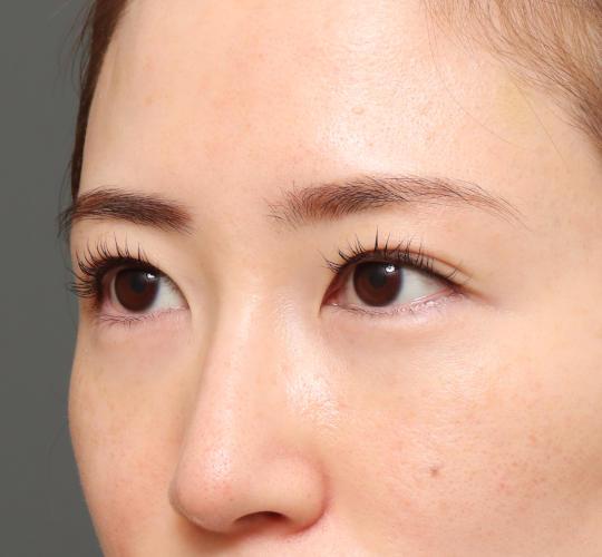 20代女性の眉下切開法 Before 症例写真