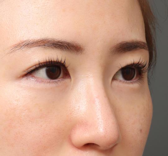 20代女性の眉下切開法 Before 症例写真