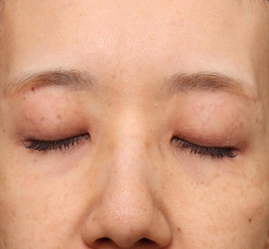 40代女性の眉下切開法 After 症例写真