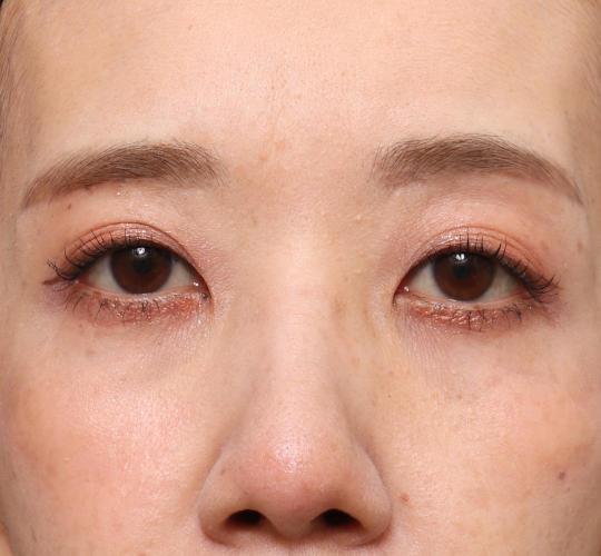 40代女性の眉下切開法 After 症例写真