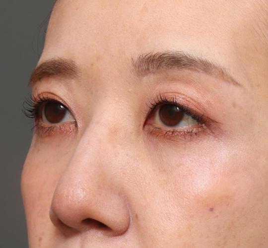 40代女性の眉下切開法 After 症例写真