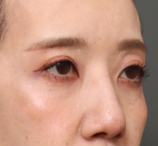 40代女性の眉下切開法 After 症例写真
