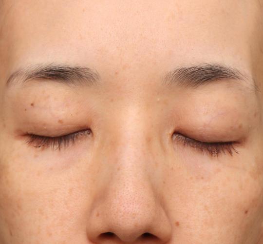 40代女性の眉下切開法 Before 症例写真