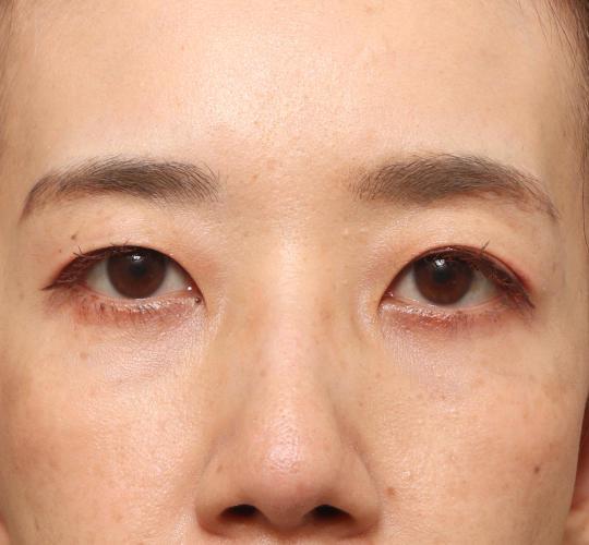 40代女性の眉下切開法 Before 症例写真