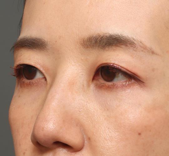 40代女性の眉下切開法 Before 症例写真