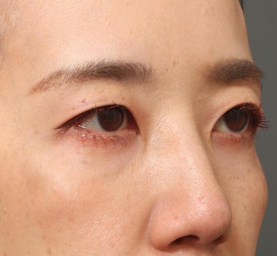40代女性の眉下切開法 Before 症例写真