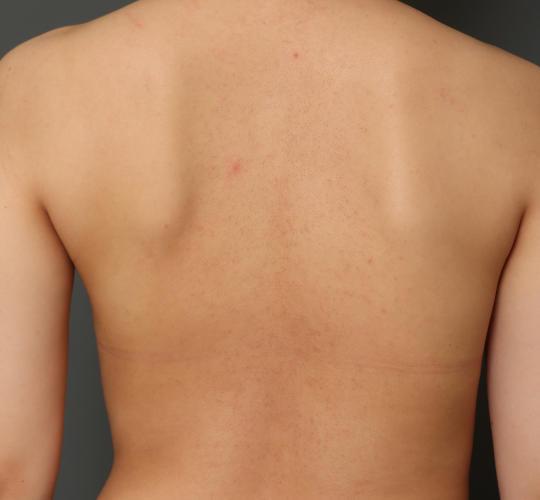 20代女性の毛孔性苔癬・角化症 After 症例写真