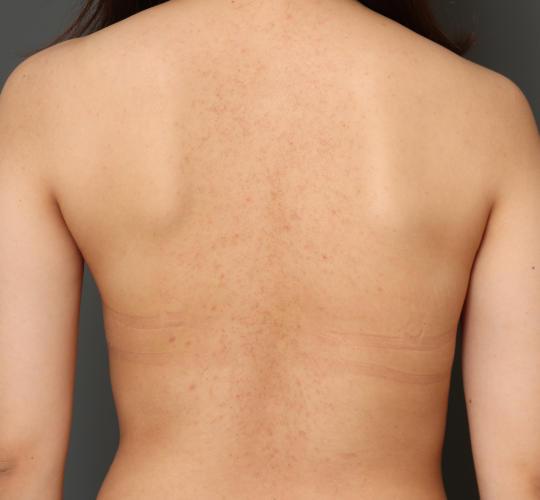 20代女性の毛孔性苔癬・角化症 Before 症例写真