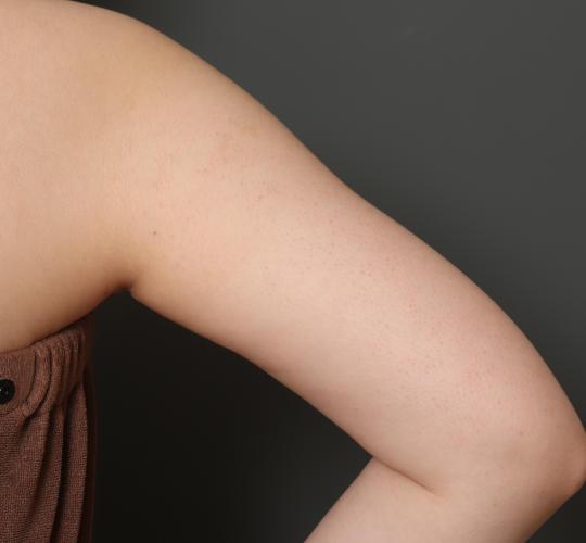 20代女性の毛孔性苔癬・角化症 Before 症例写真