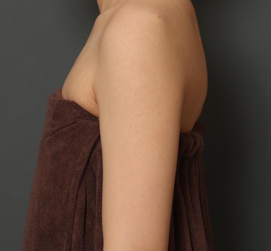 30代女性のFotonaフラクショナルレーザー（毛孔性苔癬） After 症例写真