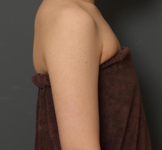 30代女性の毛孔性苔癬・角化症 After 症例写真