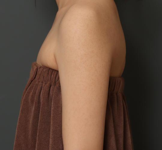 30代女性のFotonaフラクショナルレーザー（毛孔性苔癬） Before 症例写真