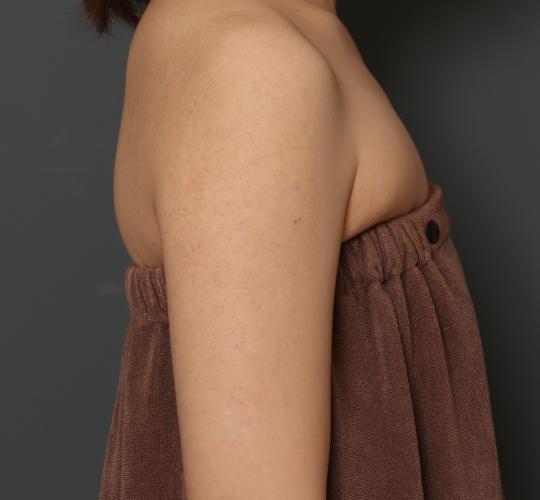 30代女性の毛孔性苔癬・角化症 Before 症例写真