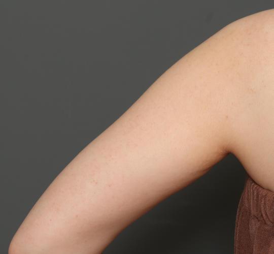 20代女性の毛孔性苔癬・角化症 After 症例写真