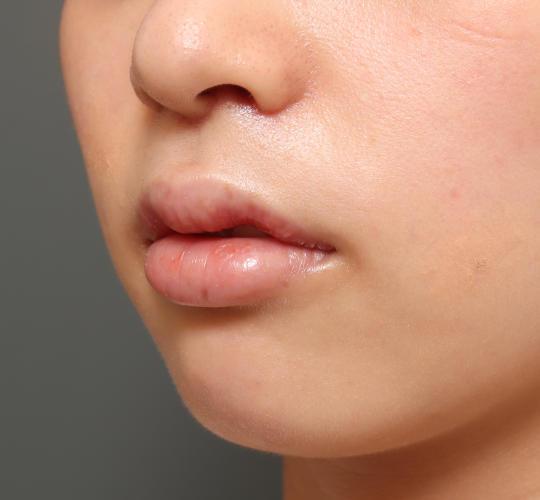 20代女性のM字リップ形成 After 症例写真
