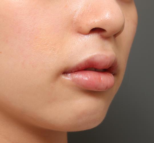 20代女性のM字リップ形成 After 症例写真