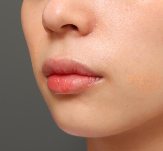 20代女性のM字リップ形成 Before 症例写真