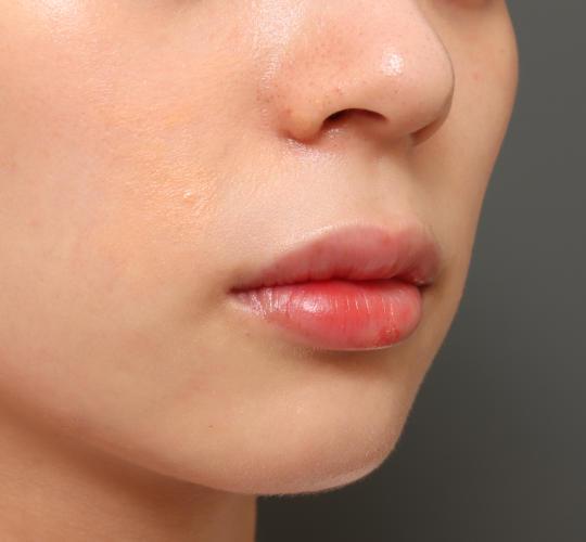20代女性のM字リップ形成 Before 症例写真