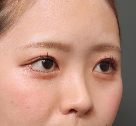 20代女性のタレ目・でか目形成 After 症例写真