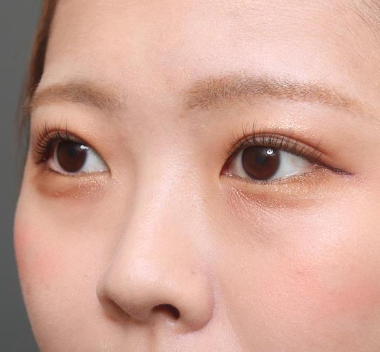 20代女性のタレ目・でか目形成 Before 症例写真