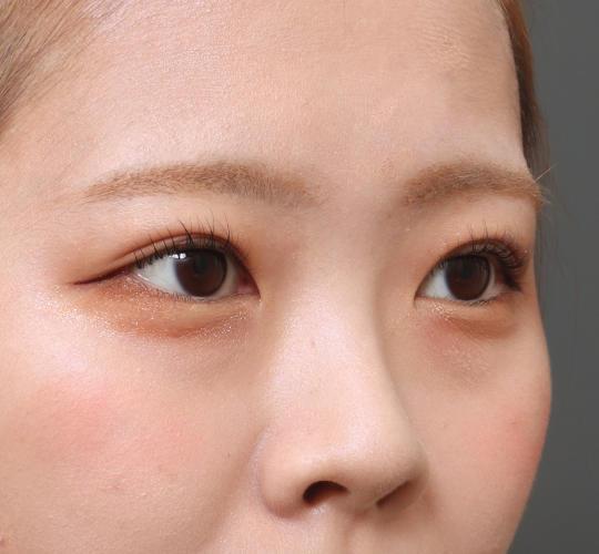 20代女性のタレ目・でか目形成 Before 症例写真