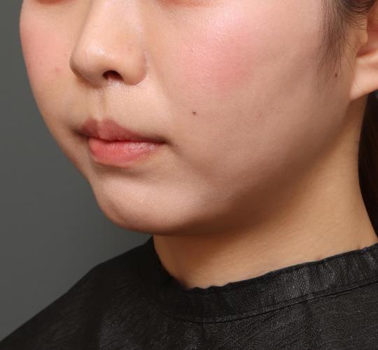 20代女性の人中短縮（リップリフト） After 症例写真