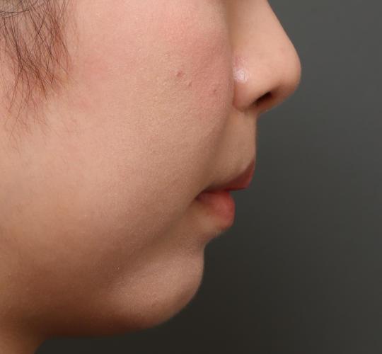 20代女性の人中短縮（リップリフト） After 症例写真