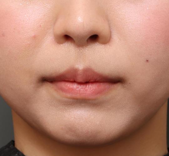 20代女性の人中短縮（リップリフト） After 症例写真