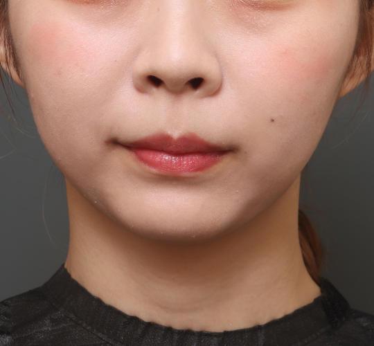20代女性の唇・口元の整形 Before 症例写真