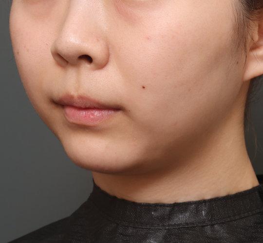 20代女性の人中短縮（リップリフト） Before 症例写真