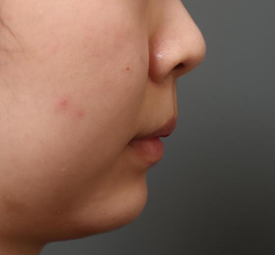 20代女性の人中短縮（リップリフト） Before 症例写真