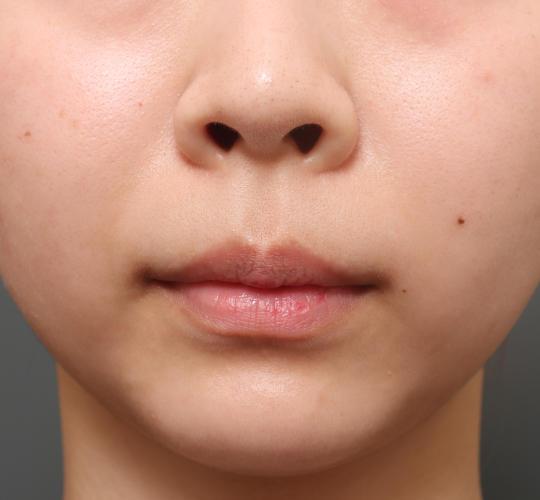 20代女性の人中短縮（リップリフト） Before 症例写真