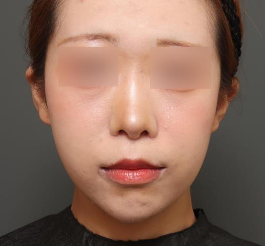 20代女性の唇・口元の整形 After 症例写真
