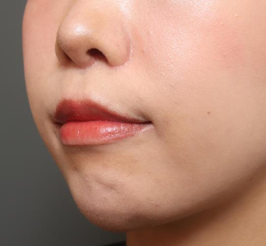 20代女性の人中短縮（リップリフト） After 症例写真