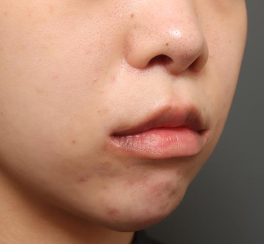 20代女性の人中短縮（リップリフト） After 症例写真
