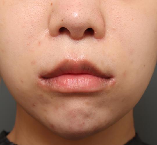 20代女性の人中短縮（リップリフト） After 症例写真