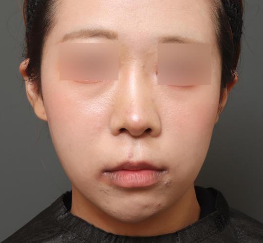 20代女性の唇・口元の整形 Before 症例写真