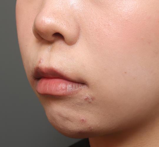 20代女性の人中短縮（リップリフト） Before 症例写真