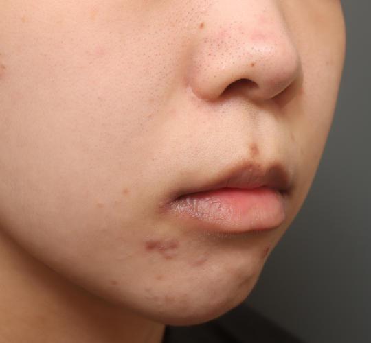 20代女性の人中短縮（リップリフト） Before 症例写真