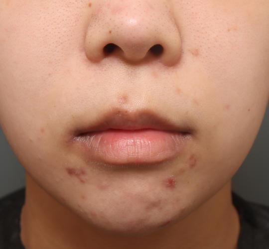 20代女性の人中短縮（リップリフト） Before 症例写真