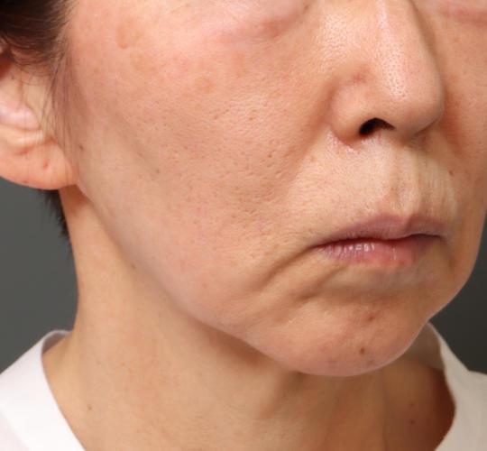 60代女性のシミ・そばかす After 症例写真