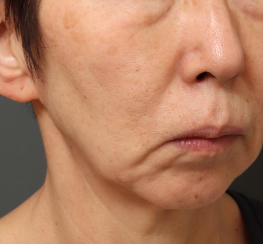60代女性のシミ・そばかす Before 症例写真