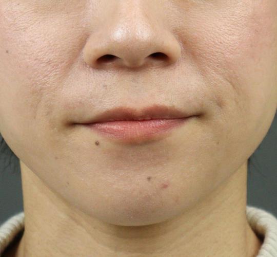 30代女性の唇・口元の整形 After 症例写真
