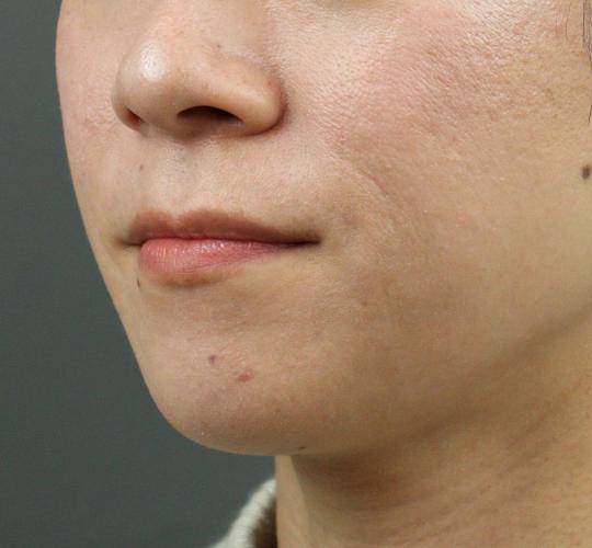 30代女性の人中短縮ボトックス After 症例写真