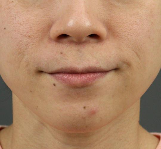 30代女性の唇・口元の整形 Before 症例写真