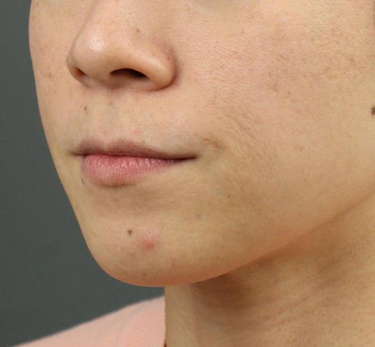 30代女性の人中短縮ボトックス Before 症例写真