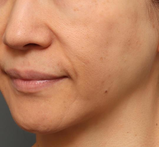 50代女性のシミ・そばかす After 症例写真