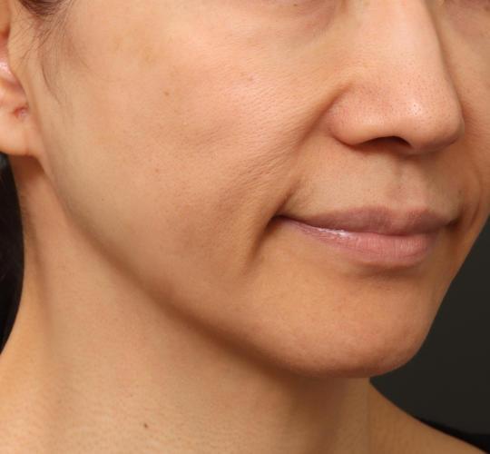 50代女性のグロウHIFUセレクトプラス After 症例写真